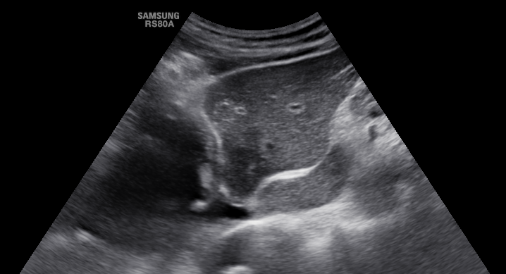 focal fatty sparing of the liver