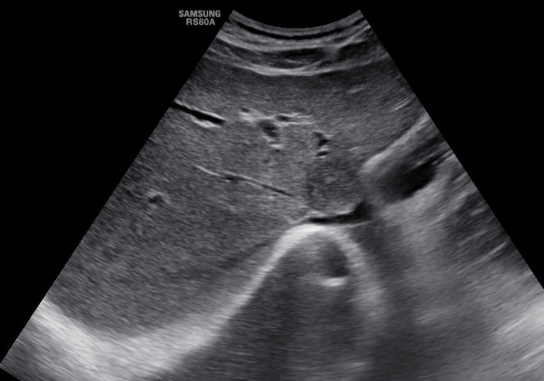 Axial view of liver, focal fatty sparing of the liver